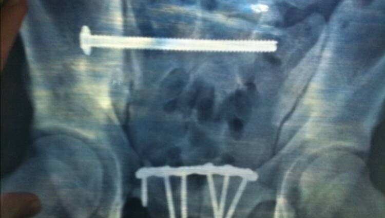 The pin inside Jason Cadee's hip.