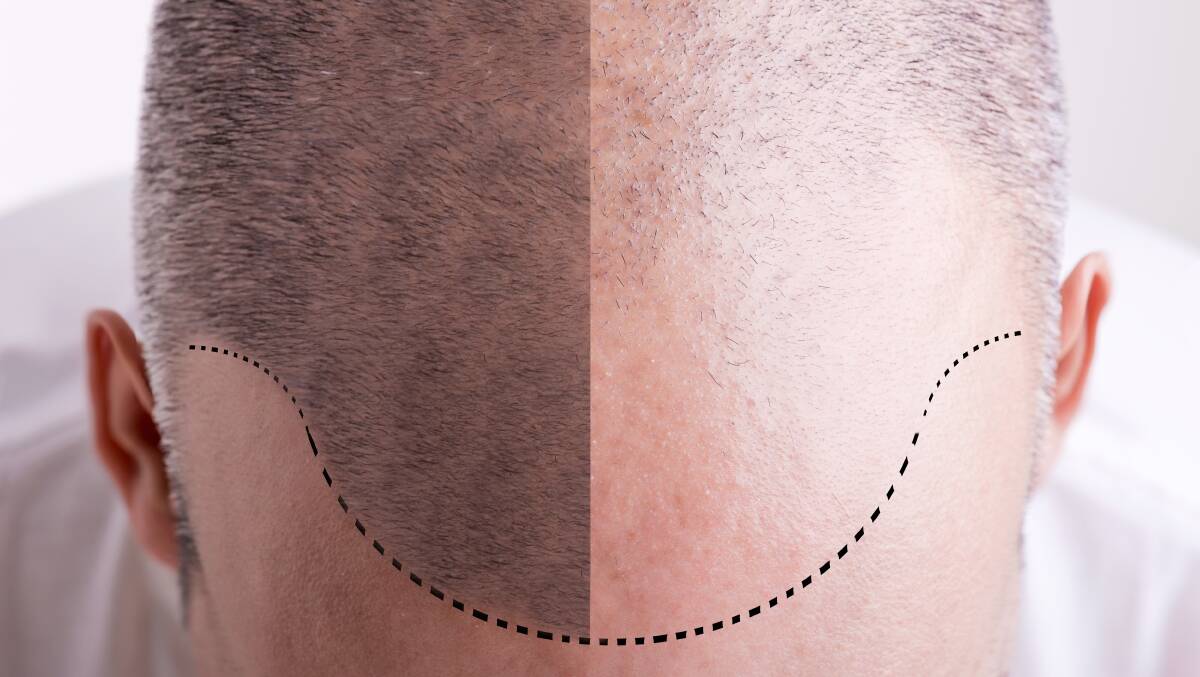 FILL IN: Hair transplants can replace the hair loss on top of the scalp.